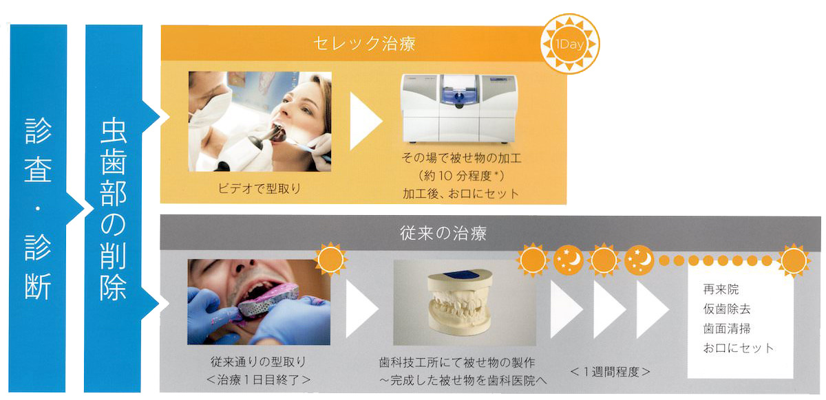 セレック１day治療の流れ